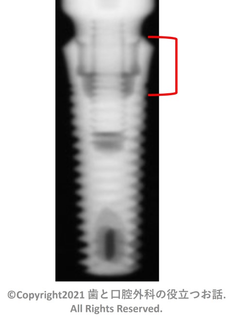 TRI Octa Implant