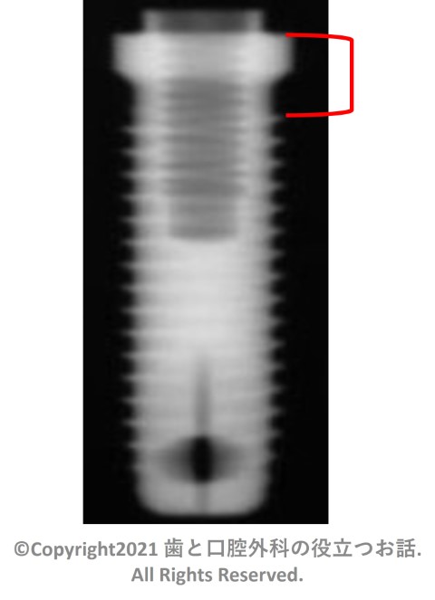 82. STERI-OSS Thread Hex Lock Implant hall