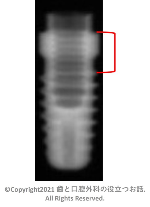 83. STERI-OSS Thread Hex Lock Implant