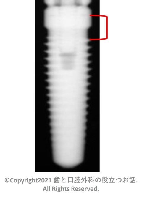 STERI-OSS Thread Replace Hex Lock Implant