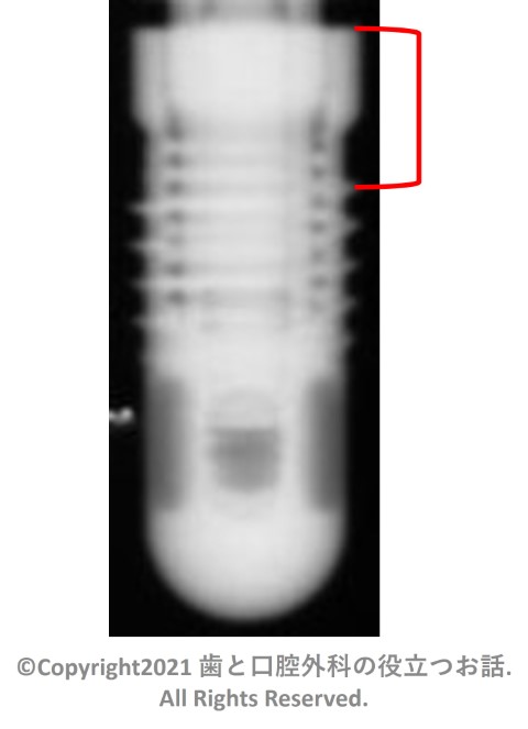 CAMLOG Cylinder Screw Implant