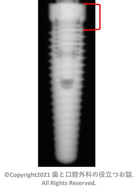 CAMLOG Root Form Implant