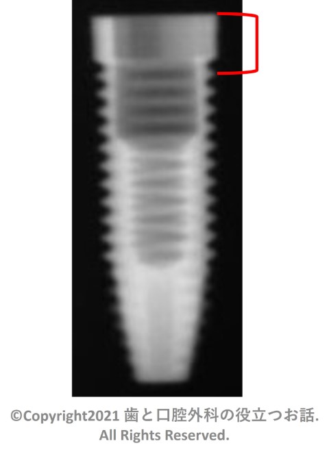 Nobel Speedy Replace Implant