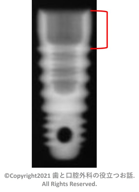 Micro Vent Implant