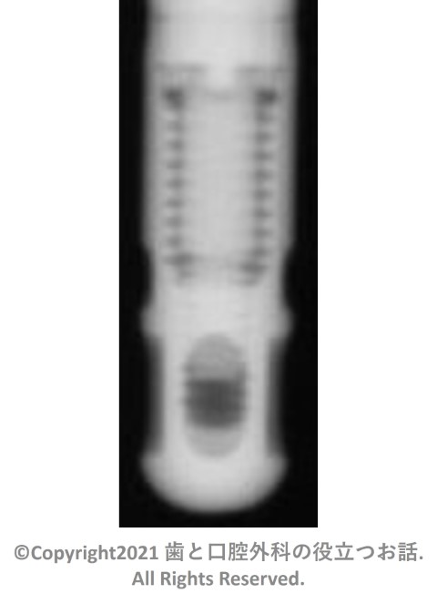 IMZ Implant TwinPlus Cylinder type