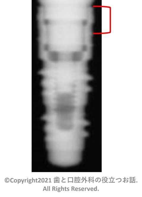 FRIALIT2 Step Screw Implant