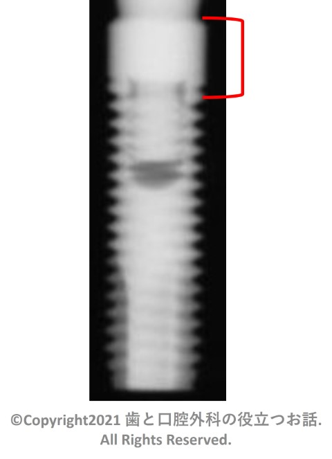 Astra Tech TioBlast Implant