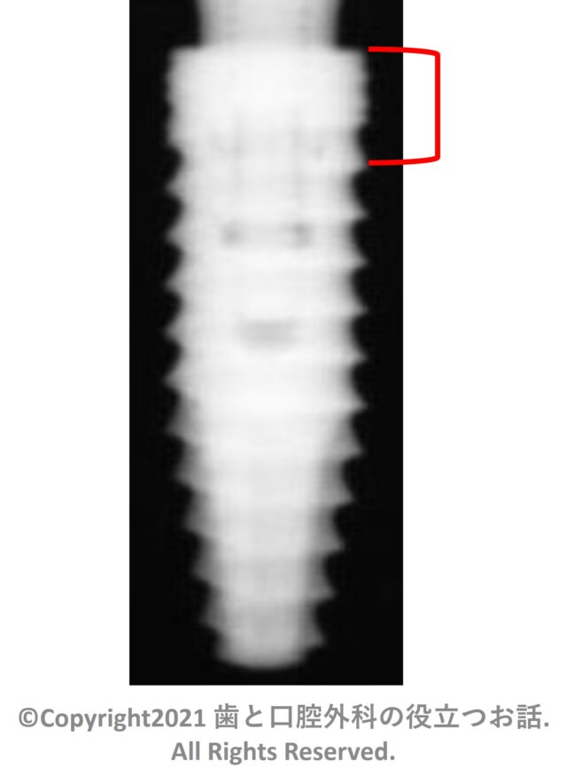 CONELOG PROGRESSIVE LINE Implant