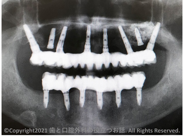 全顎インプラントのパノラマエックス線画像