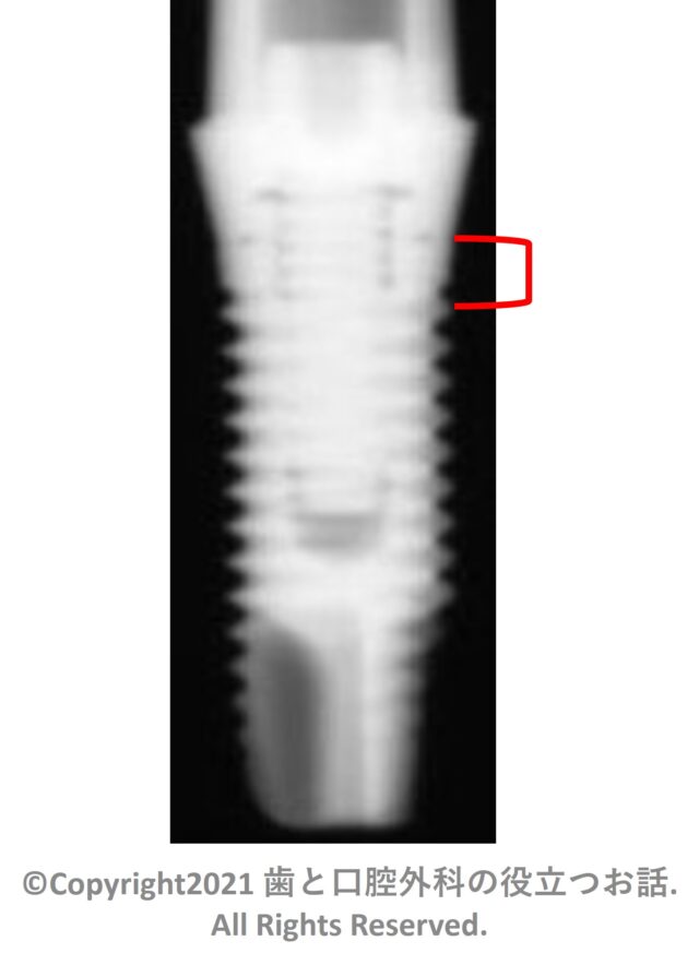 EMINEO Implant