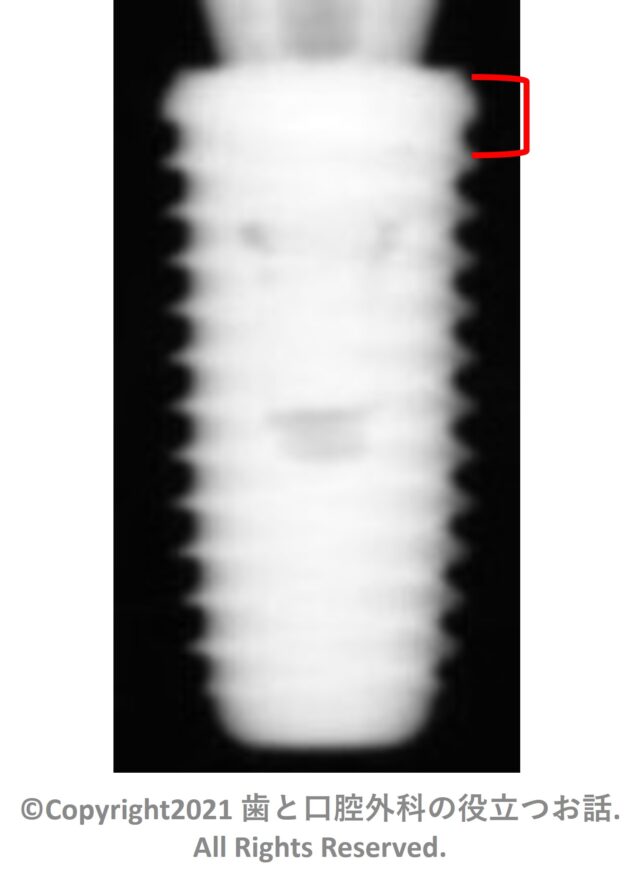 Octafix BL Implant