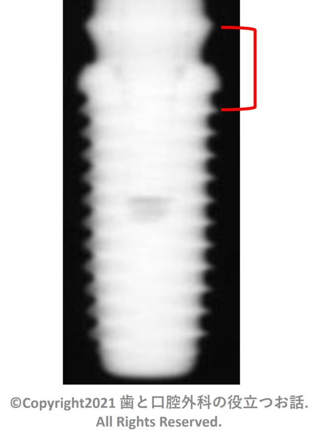 Octafix TL Implant