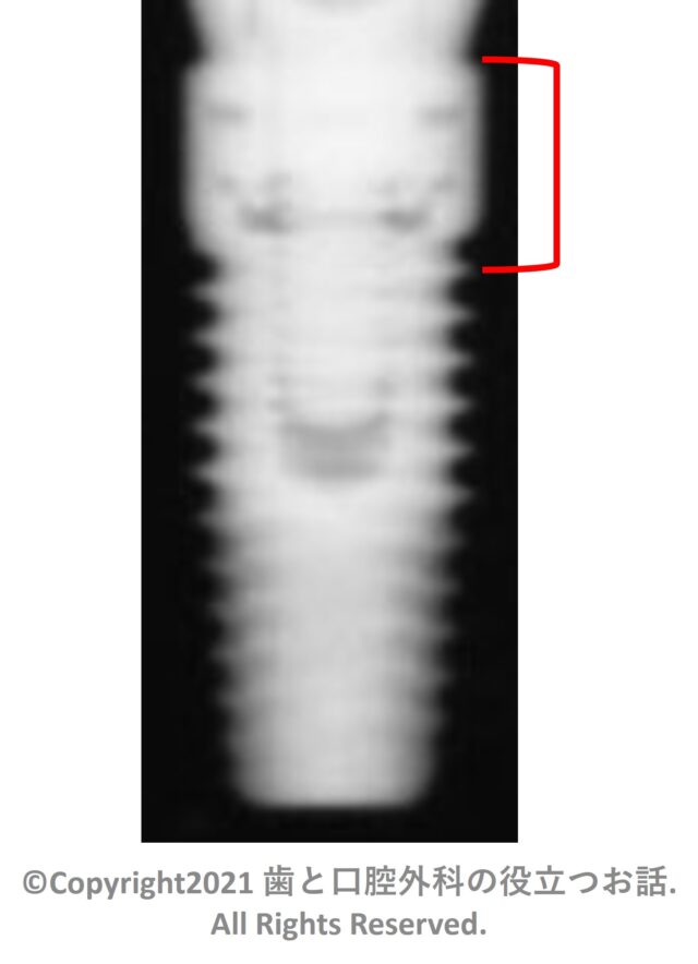 Prima Connex Straight Implant