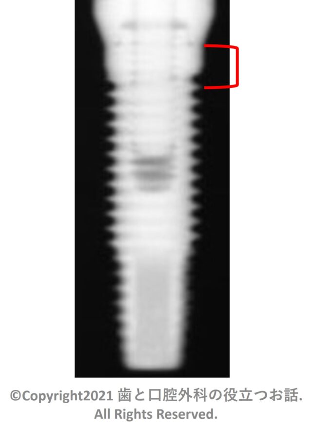 Restore RBM Implant