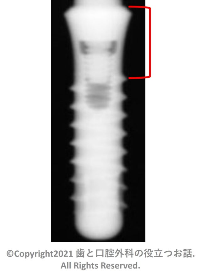 Stage-1 RBM Implant