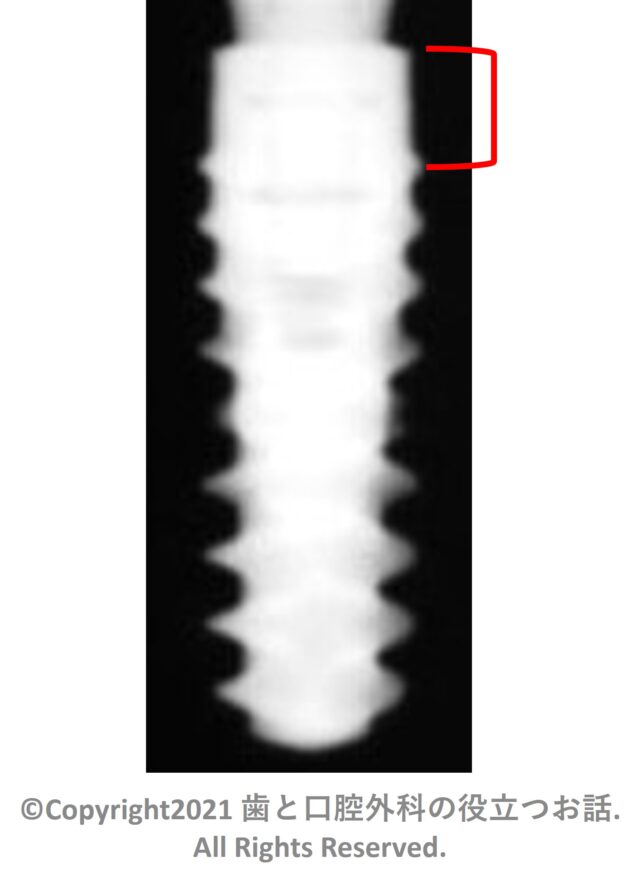 Straumann BLX Implant