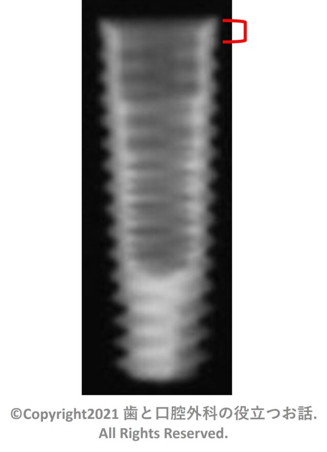 TRI Narrow Implant