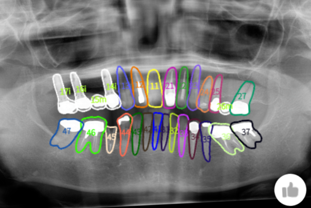 歯科エックス線AI