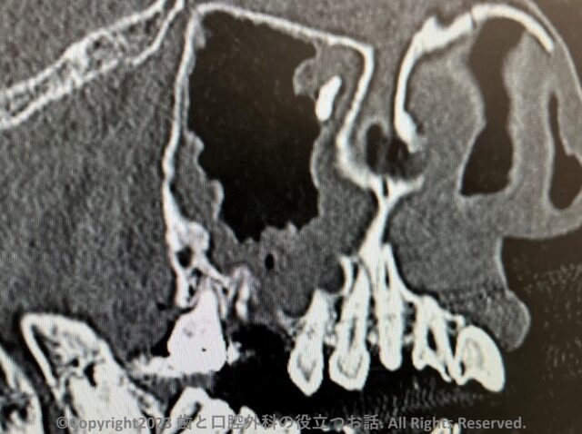 上顎洞迷入異物 インプラント