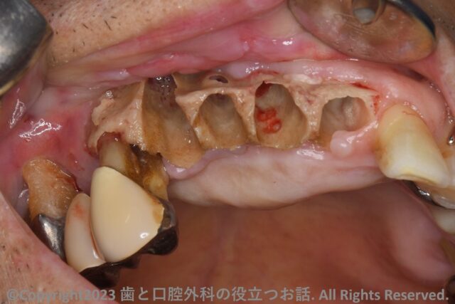 MRONJ 薬剤関連顎骨壊死 ポジションペーパー 2023