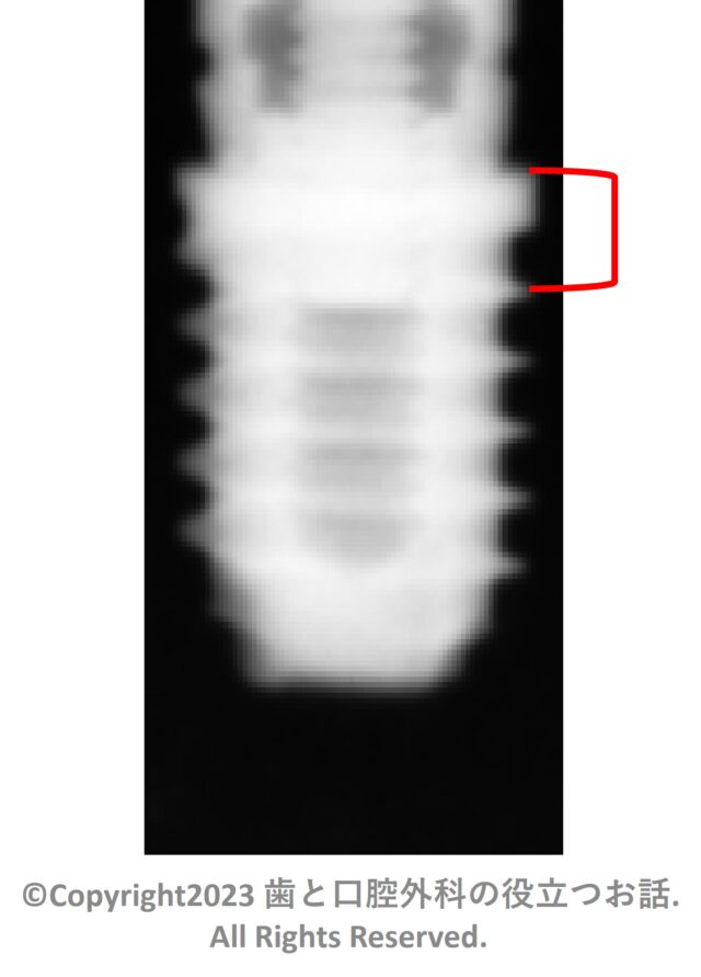 T3 ショート インプラント