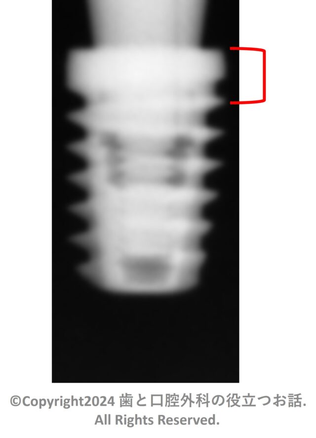 Aadva Short Implant