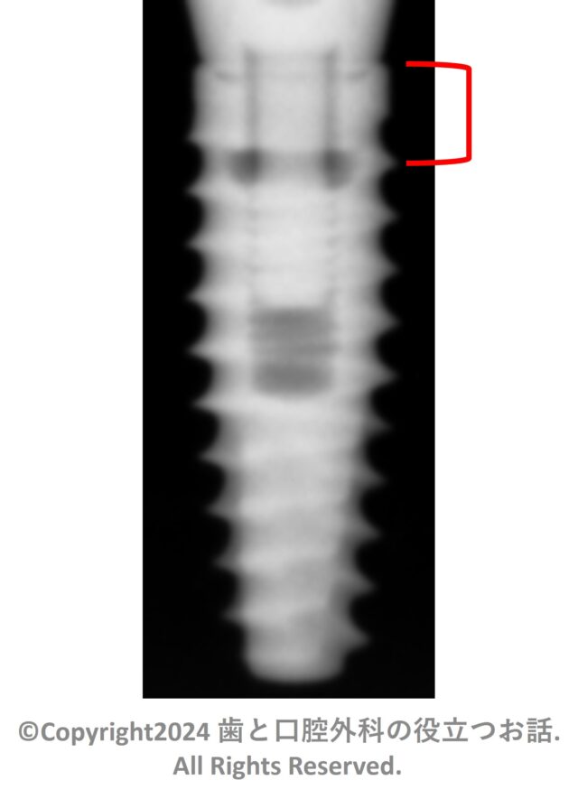 BioHorizons Taperd Pro Implant