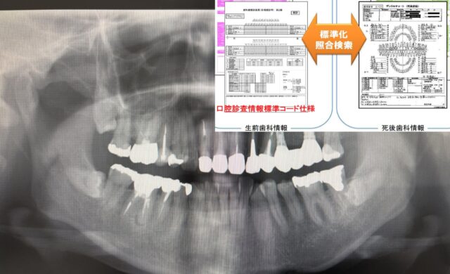 パノラマX線画像AIによる個体識別・身元確認